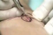 riduzione dei tatuaggi