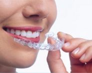 metodo Invisalign